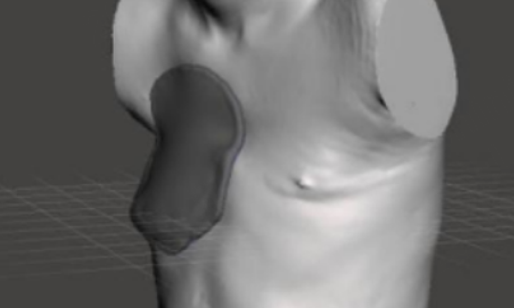 Breast Prosthesis